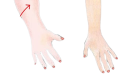 Lymphedema-removebg-preview Lymphedema-removebg-preview